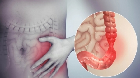 ما هو الرابط بين القولون العصبي والقلق؟