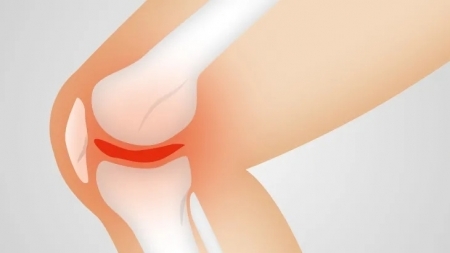 أعراض ‫التهاب المفاصل الروماتويدي