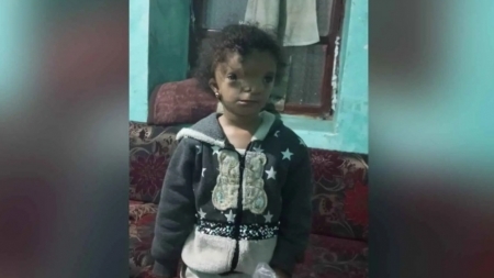 لأجل طفلته "المشوهة".. يمني يعرض كليته للبيع