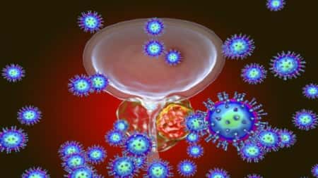 صحة: 10 أعراض لسرطان البروستات