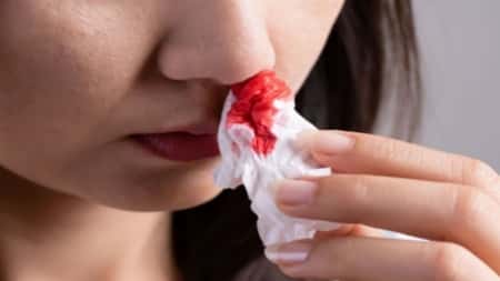صحة: الأسباب الرئيسية لنزيف الأنف