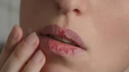 صحة: لماذا تتشقق الشفاه وهل يشير ذلك إلى حالة مرضية؟