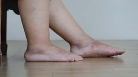 صحة: احتباس الماء في الجسم..كيف يمكن التخلص من السوائل الزائدة؟