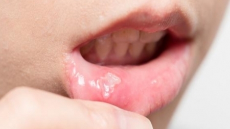ما هي فطريات الفم وكيف يمكن علاجها؟
